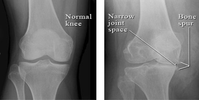 Showing x-ray of normal knee joint and knee joint osteoarthritis