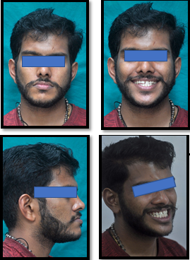 Pre-treatment extra oral photographs