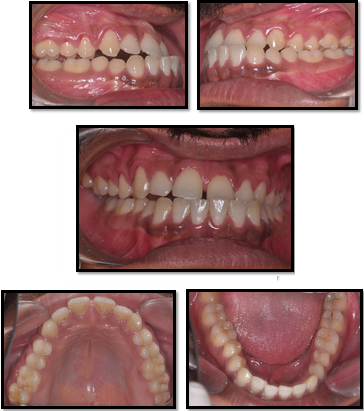 Pretreatment intra oral photographs