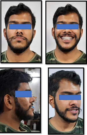 Extra oral mid treatment photographs