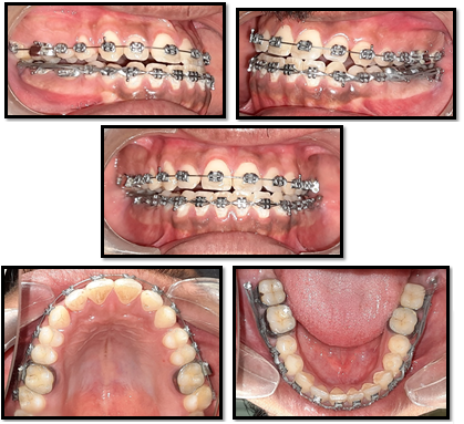 Intra oral mid treatment photographs