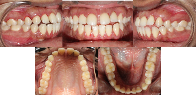 Pre-treatment intro-oral photographs.