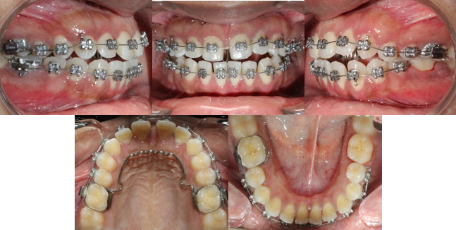 Strap up intra-oral photographs