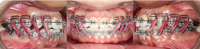 MEAW for anterior open bite closure