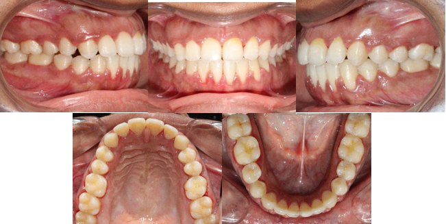 Post-treatment intro-oral photographs.