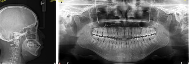 Post-treatment radiographs