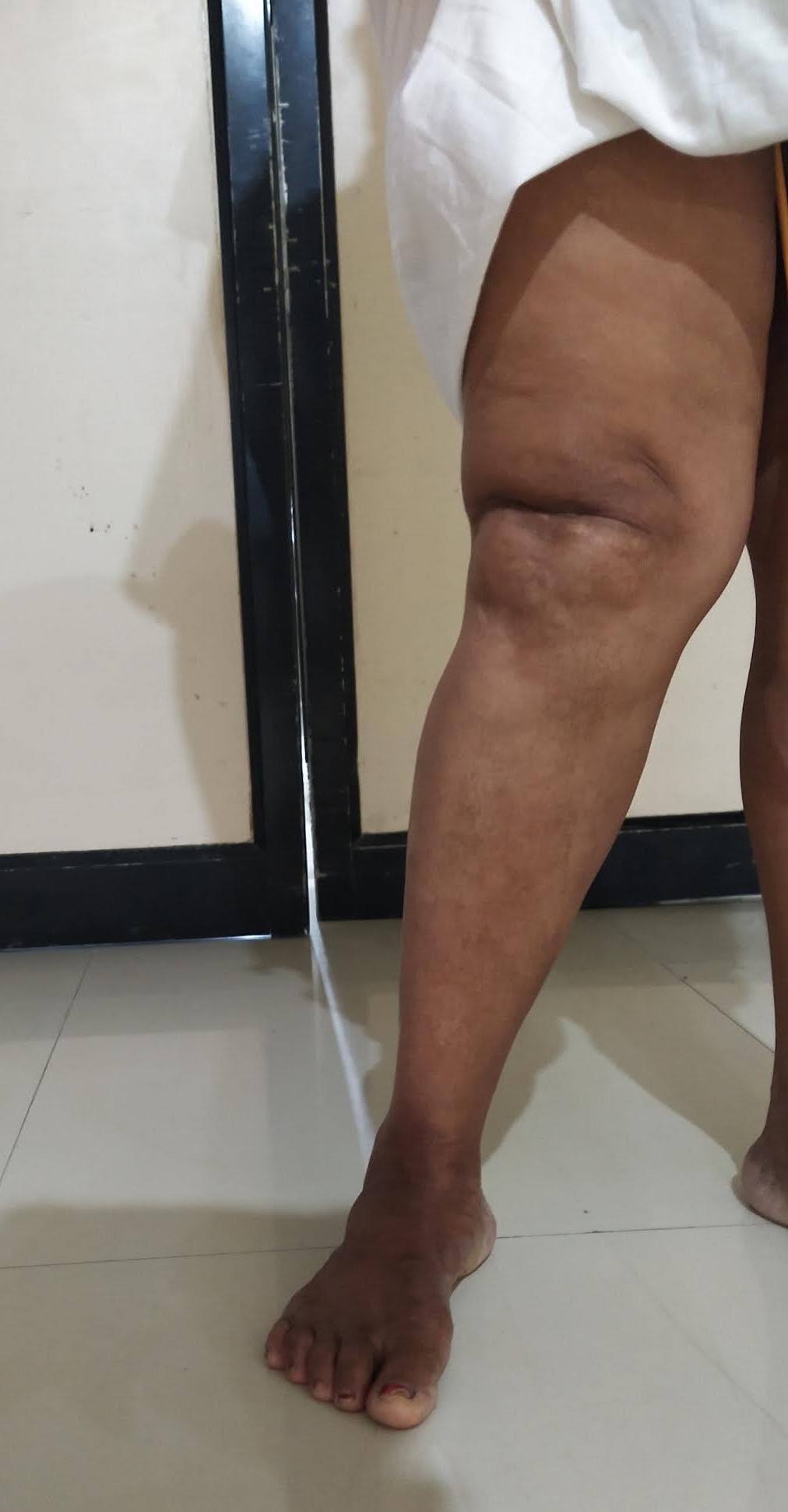 Obese patient with valgus knee
