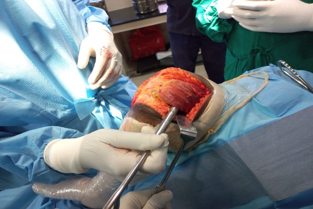 Sub vastus approach and vastus medialis exposed well