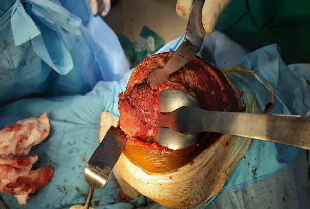 Lateral corner of tibial plateau exposed