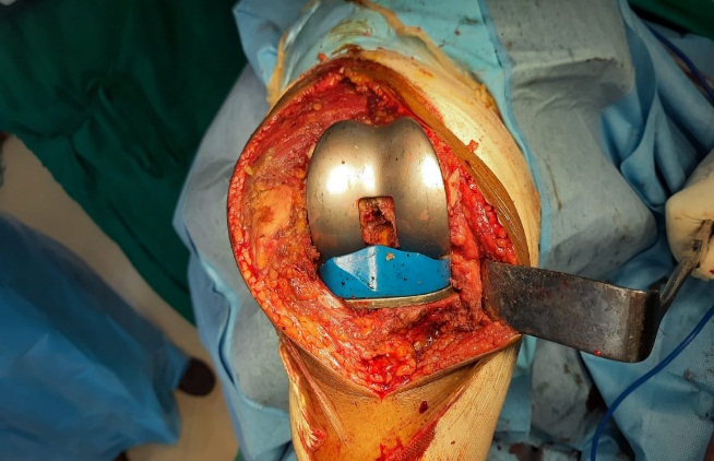Final trail implant position