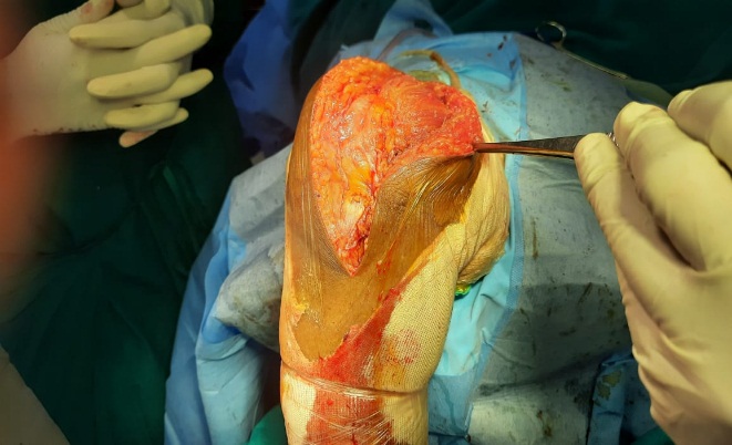 Closure of wound with minimal bleeding