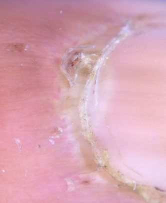 Ragged cuticle in a patient with systemic lupuserythematosus