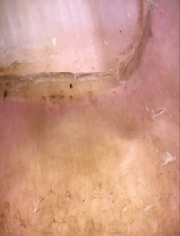 Splinter hemorrhage in a patient with systemic lupus erythematosus