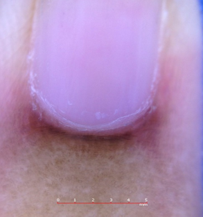 Proximal nail fold erythema in a patient with systemic lupuserythematosus