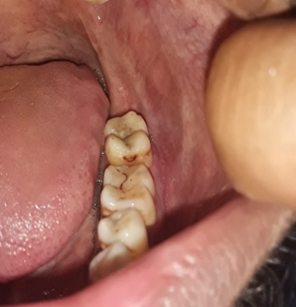 Case 1 After YPV healing