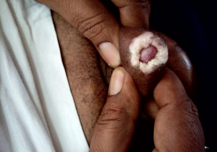 LSEA- Well defined depigmented atrophic patch on the prepucial skin with phimosis.