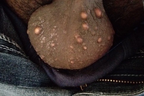 Steatocystoma multiplex.