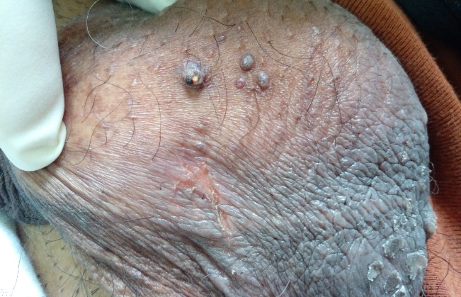 Angiokeratoma- Discrete dark colored papules on the scrotum.