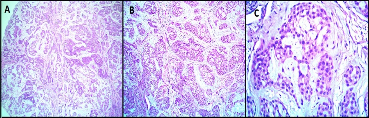 Hematoxylin and Eosin (H&E) images of glomus tumor (Case 8) showing a well circumscribed tumor composed of uniform round to oval cells with monomorphic round nuclei and scanty eosinophilic cytoplasm arranged in nests. The stroma shows myxoid material. No nuclear atypia, necrosis or mitosis. (A -40X magnification, B-100X magnification, C- 400X magnification)