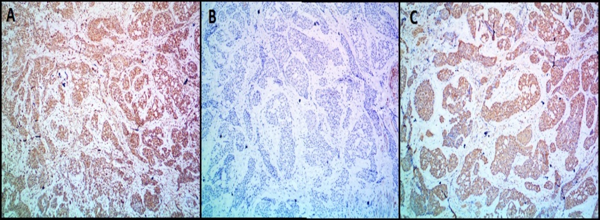 Immunohistochemistry (IHC) images of glomus tumor (Case 8) showing tumor cells expressing; A): Vimentin and C): Smooth Muscle Actin (SMA). Tumor cells are negative for B): Desmin (A,B,C- 100X magnification)