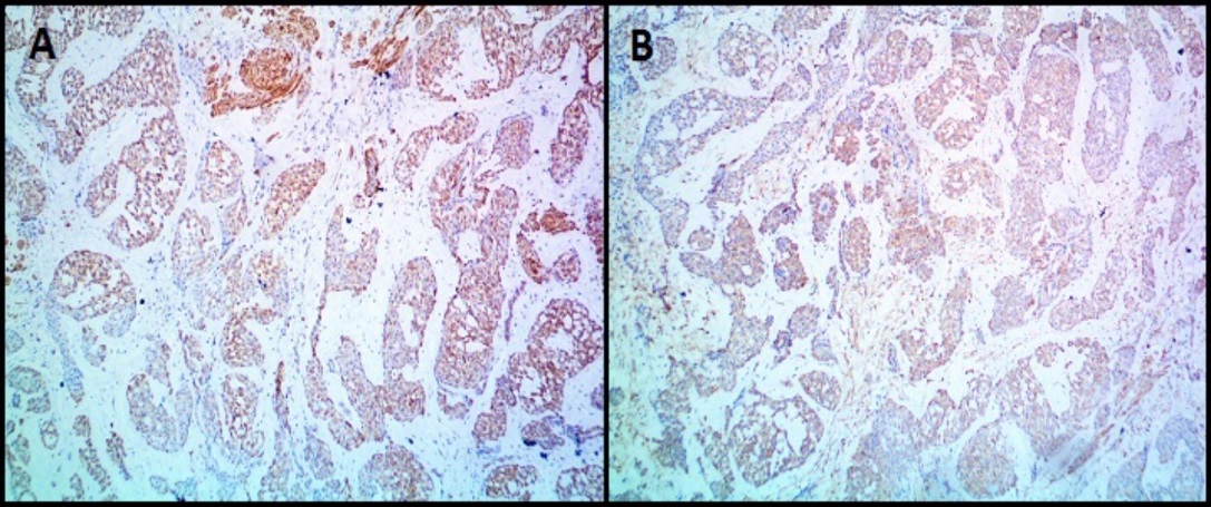 IHC images of glomus tumor (Case 8) showing expression of A): Calponin and B): High-molecular-weight Caldesmon (H- Caldesmon). (A & B-100X magnification)