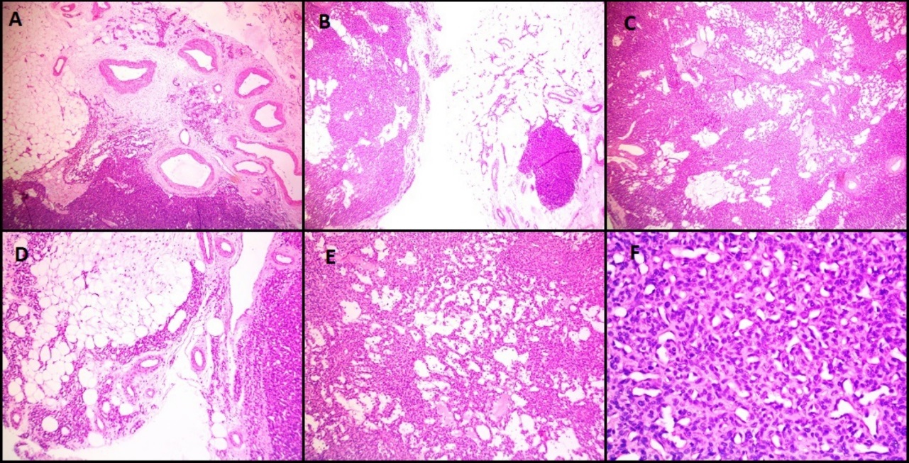 H&E images in a case of glomangiomatosis (Case 4) showing diffuse infiltrating multifocal tumor with prominent vasculature surrounded by glomus cells without nuclear atypia (A, B, C- 40 X magnification), D, E- 100X magnification, F-400X magnification)