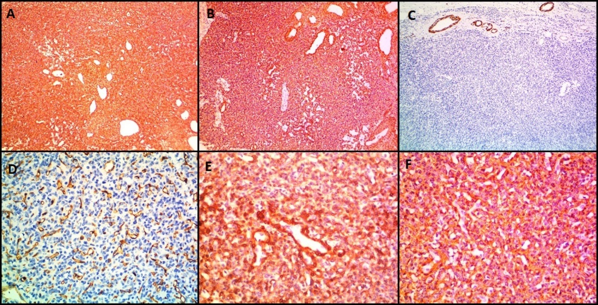 IHC images in case of glomangiomatosis (Case 4) showing expression of A): Vimentin, B): SMA, E): Calponin and F): H-Caldesmon. The tumor cells are negative for C): Desmin and D): CD34. CD34 stain highlights prominent vasculature. (A,B,C,D- 100X magnification, E, F- 400X magnification)
