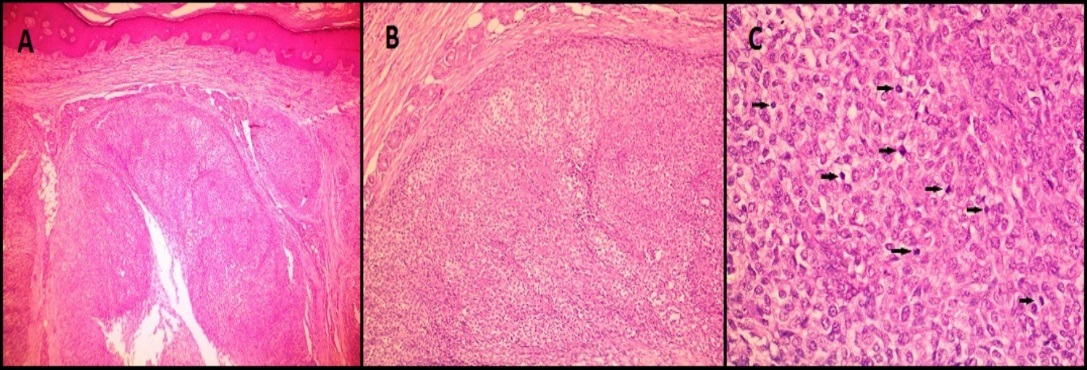 H&E images in case of malignant glomus tumor (Case 6) showing A): A subcutaneous lobulated tumor; B): composed of round epithelioid cells; C): with large hyperchromatic nuclei and clear cytoplasm. Black arrows point to the mitotic figures. (A-40X magnification, B: 100X magnification, C- 400 X magnification)