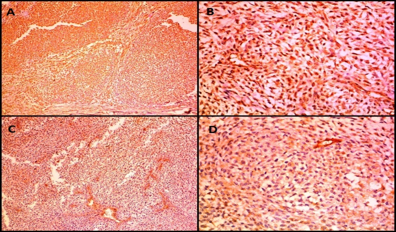 IHC images in a case of malignant glomus tumor (Case 6) showing expression of A): Vimentin, B): Smooth Muscle Actin (SMA), C) Calponin D): H-Caldesmon (A, C-100X magnification, B, D-400X magnification)