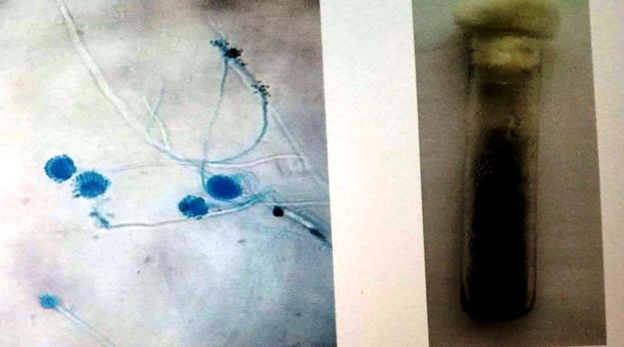 LPCB mount of Aspergillus fumigatus showing conidiophores, philalides covering upper half vesicle and conida. (Left), SDA showing growth of Aspergillus fumigatus (Right).
