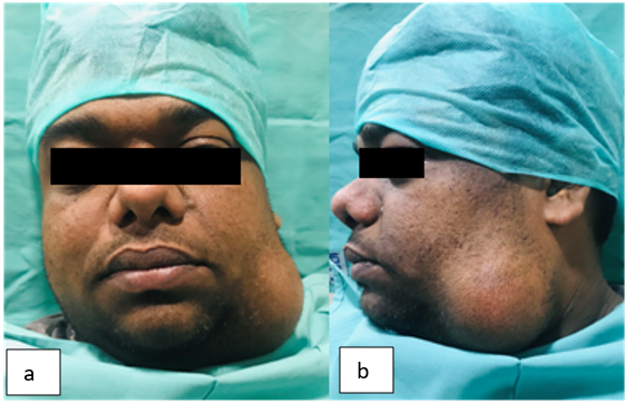 Pre operative: a: Frontal; b: Lateral