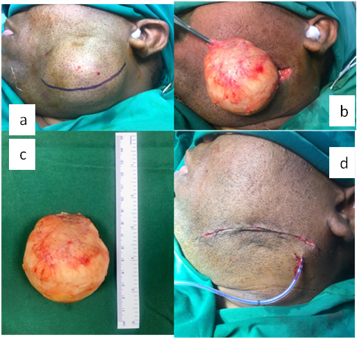Intra operative; a: Elliptical devolving incision; b & c: Excised mass; d: Closure done and drain placed