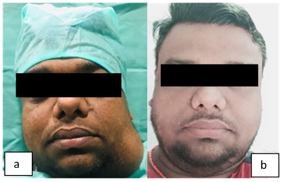 a: Preoperative clinical picture; b: Post operative clinical picture)