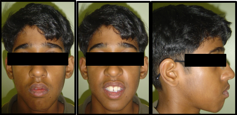 Pre treatment extraoral photographs