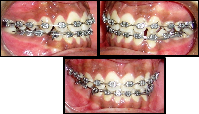 Treatment intraoral photographs