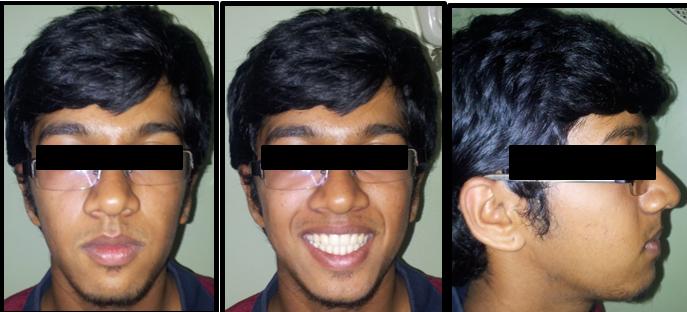 Post genioplasty and septoplasty (1 year follow up)