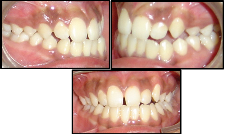 Pre treatment intraoral photographs