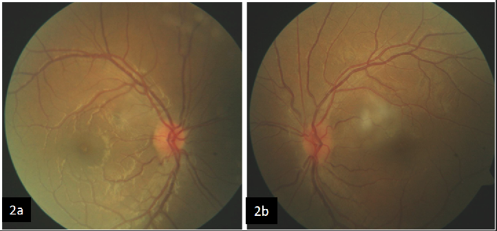 a: Fundus photo of right eye showing resolved disc edema with clear disc margins. b: Fundus photo of left eye showing resolved disc edema with clear disc margins.