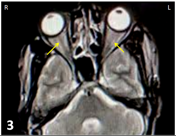Post contrast T2 weighted MRI image (axial scan) showing subtle optic nerve sheath enhancement (yellow arrow) in both eyes.