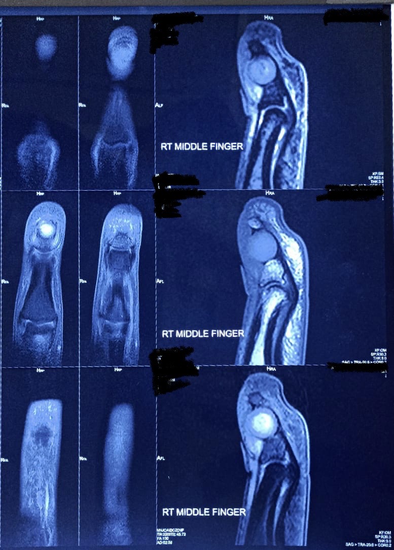 Preoperative well-defined spherical lesion on the middle finger's distal phalanx with eccentric phalanx erosion