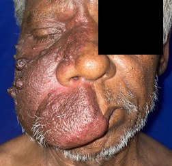 Unilateral facial portwine stain with soft tissue hypertrophy