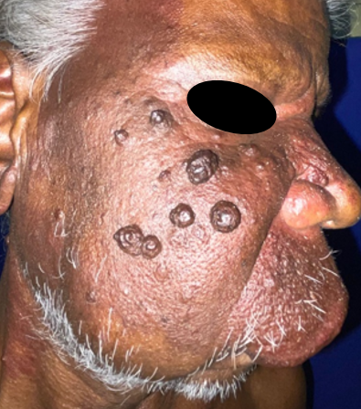 Nodularity over port wine stain