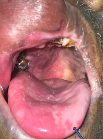 Ipsilateral mucosal staining over right buccal mucosa, palate and tongue with red macular islands on contralateralside (Blue arrow)