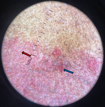  Dermoscopy showing dot vessels (Red arrow) Linear vessels (Blue arrow)