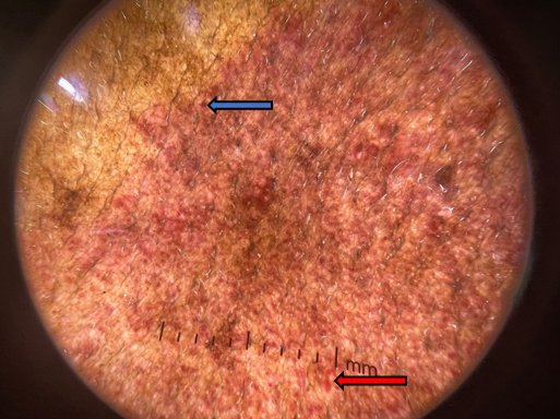  Globule vessels (Blue arrow) Sausage vessels (Red arrow)
