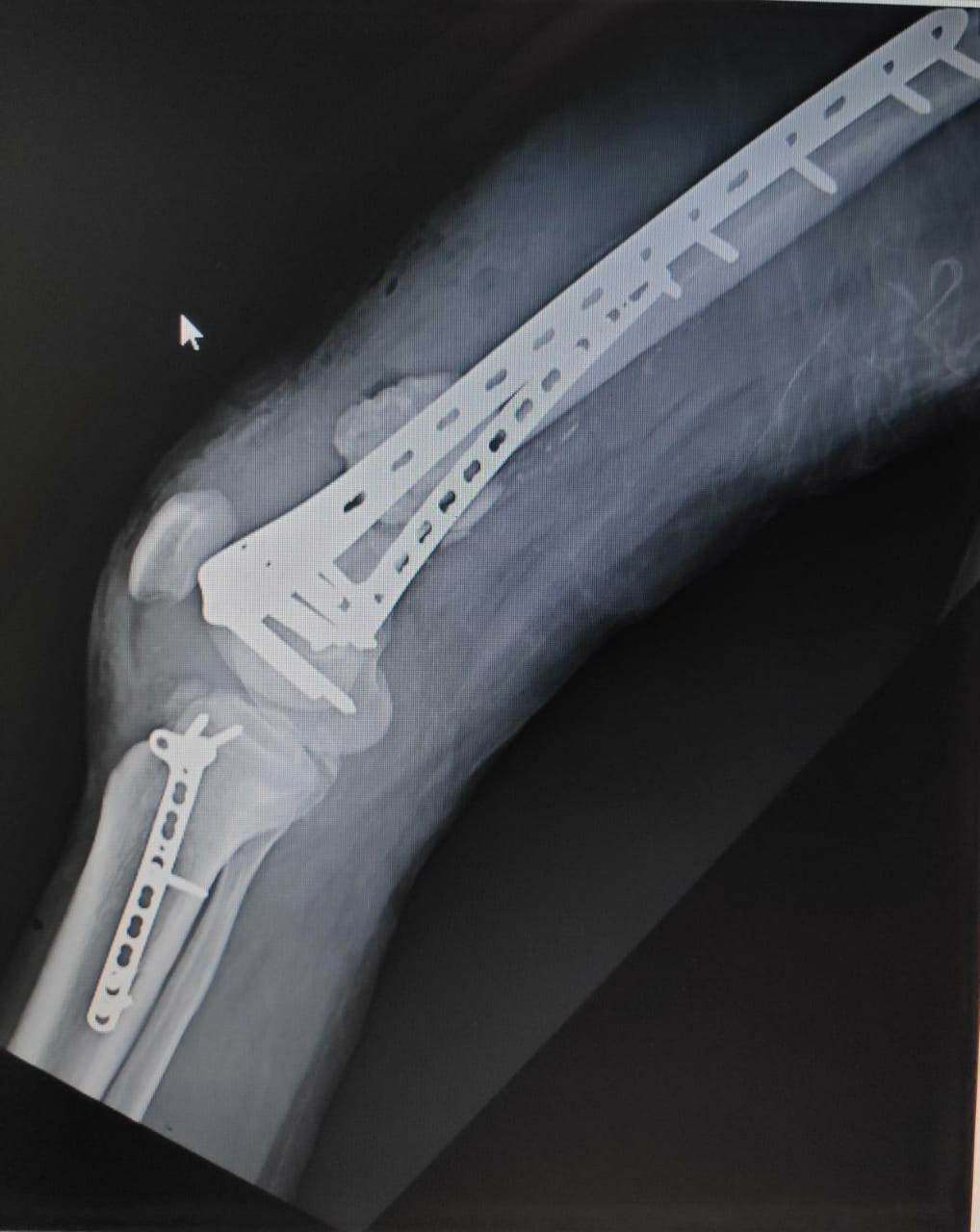 Showing the lateral view after stage 1