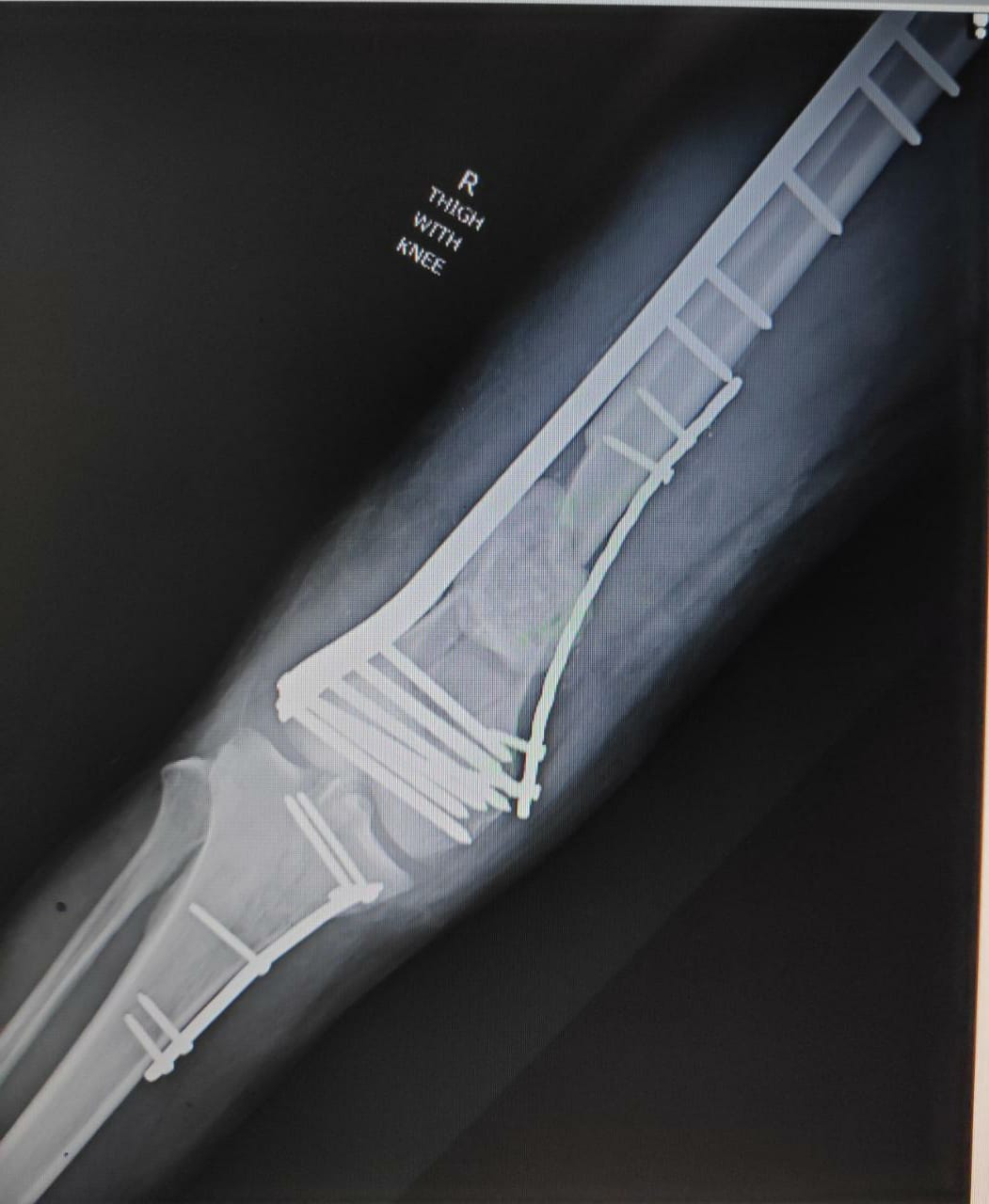 Post-op x-ray ap view after stage 1