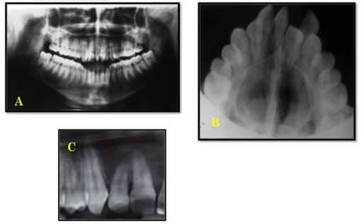 Pretreatment radiographs: A: OPG, B: Occlusal view, C: Dilacerated root of 12