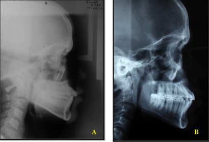 Pre-treatment Cephalogram, B: Post-treatment Cephalogram