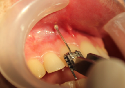 Bracket placement on the tooth